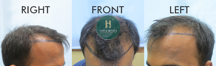 Hairline Designing 4155